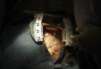 أول عملية قلب مفتوح مباشرة عبر موقع التويتر